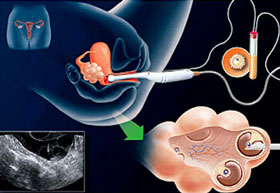 Diagnoza Gjenetike Pre- Implantive