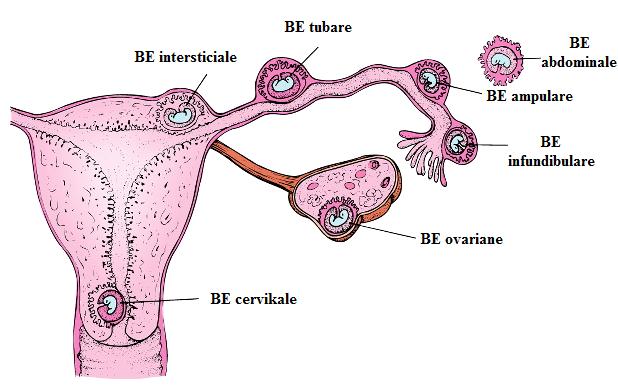 Barra Ekstrauterine