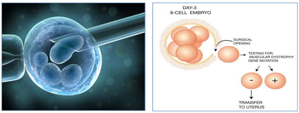 Depistimi Gjenetik Pre-implantacional