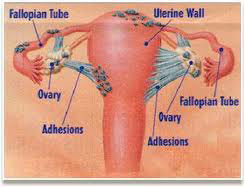 Endometrioza