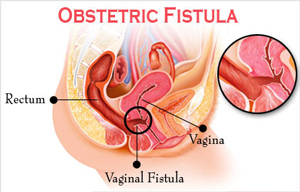 Fistula Obstetrikale