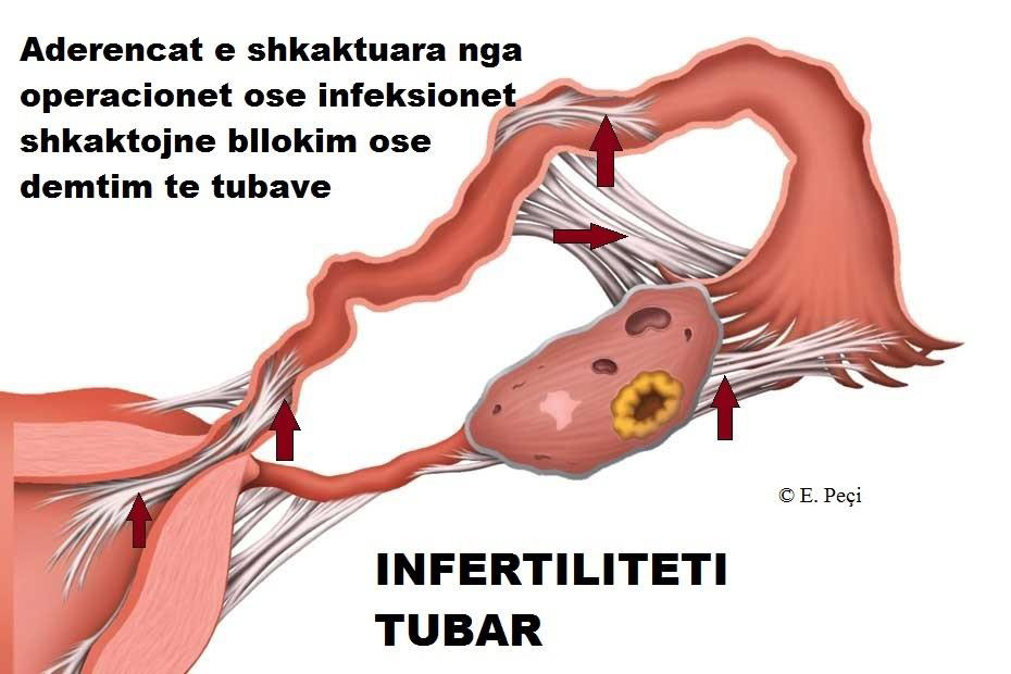 Infertiliteti Tubar