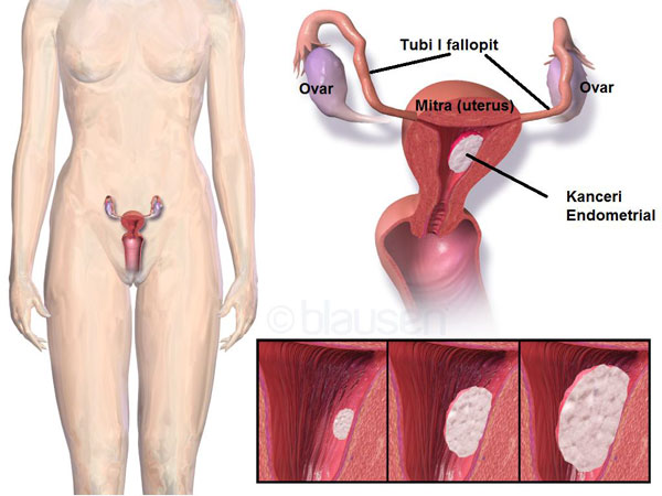 Kanceri Endometrial