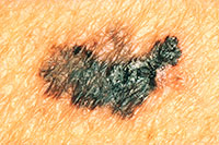 Melanoma