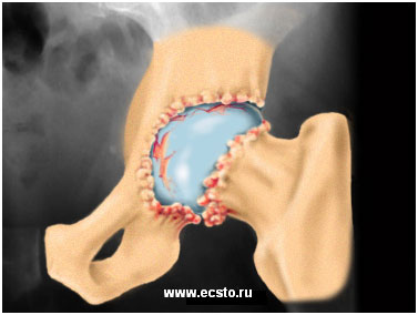 OsteoArtriti