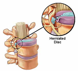 Ozoneterapia Ne Hernien Diskale 