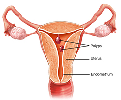 Polipi Endometrial Dhe Cervikal