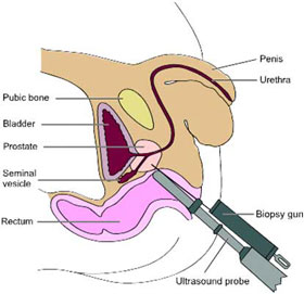 Biopsia Transrektale E Prostates
