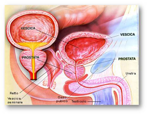 Hipertrofia Benigne E Prostates