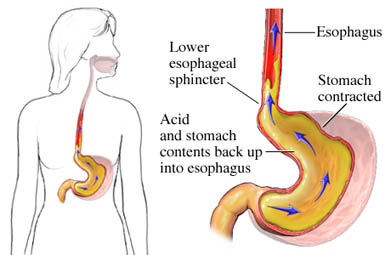 Refluksi Gastroezofageal