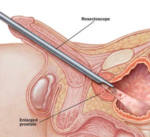 Rezeksioni Transuretral I Prostates