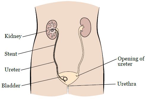 Çfarë Duhet Të Dini Për Stentat Ureterale