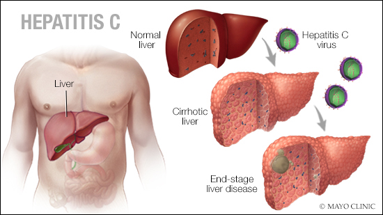 Hepatiti C