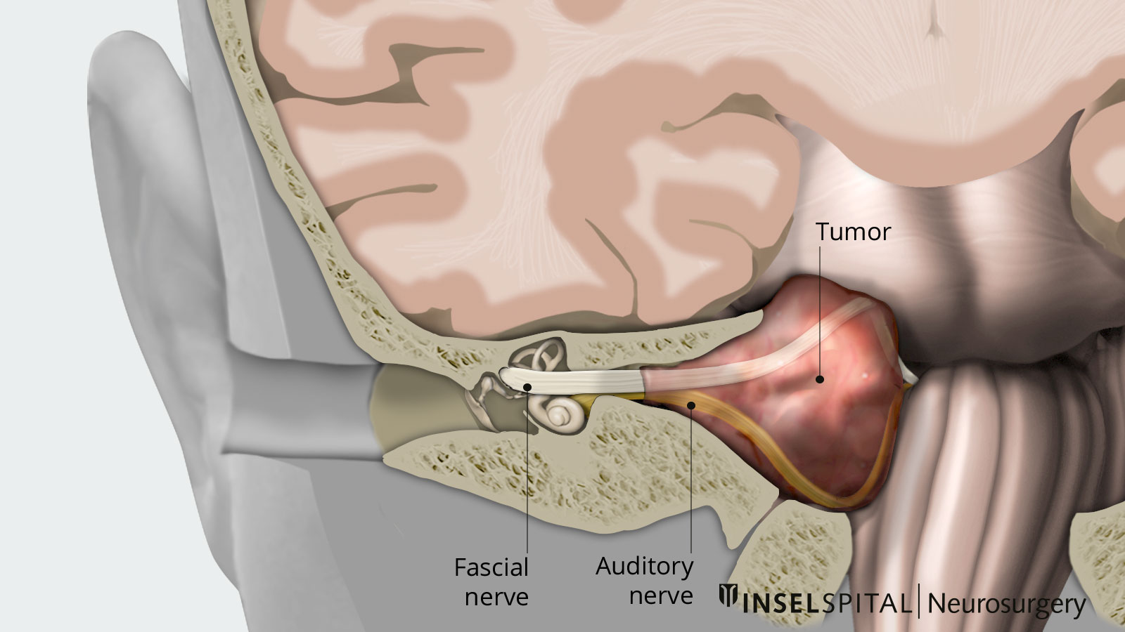 Neurinoma Akustike (Schwannoma, Schwannoma Vestibulare, Tumori I Këndit Ponto-cerebelar)