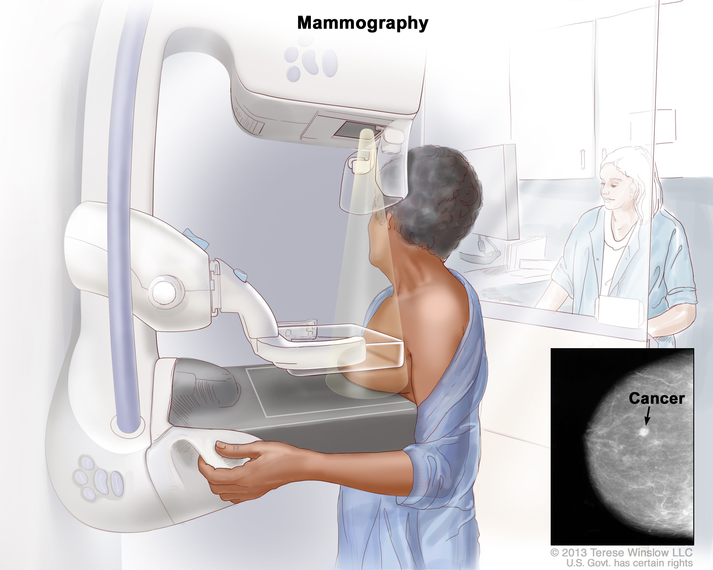 Mamografia: Një Mjet I Rëndësishëm Për Diagnostikimin E Hershëm Të Kancerit Të Gjirit