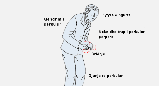 Sëmundja E Parkinsonit