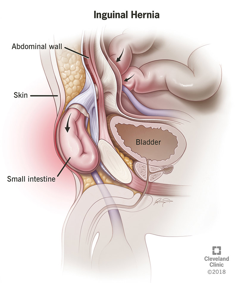 Hernia Inguinale