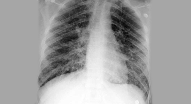 Pneumonia (Inflamacioni I Mushkërive)