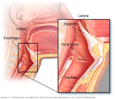 Epiglotiti