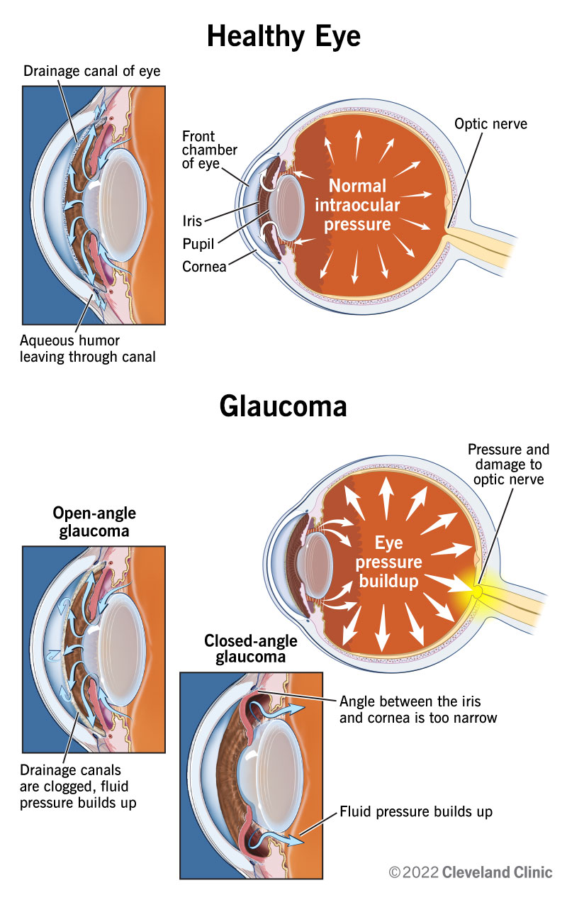 Çfarë është Glaukoma?