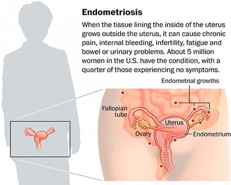 Çfarë duhet të dihet për endometriozën