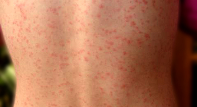 Ethja Tre Ditore (Roseola Infantum, Temperatura Tre Ditore)