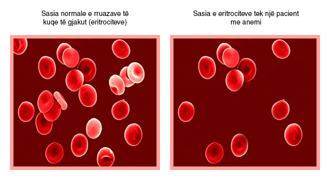 Anemia Nga Mungesa E Hekurit (Anemia Ferriprive)