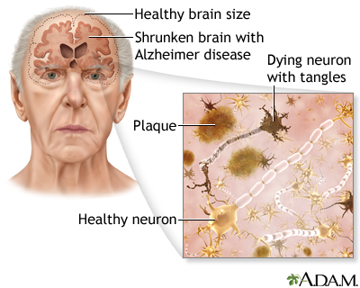 Çfarë duhet të dimë për sëmundjen e Alzheimerit