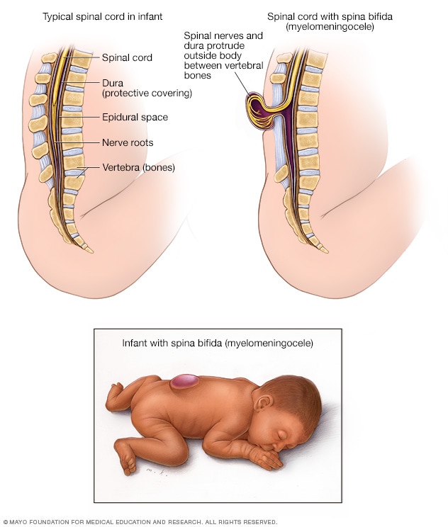 Spina Bifida