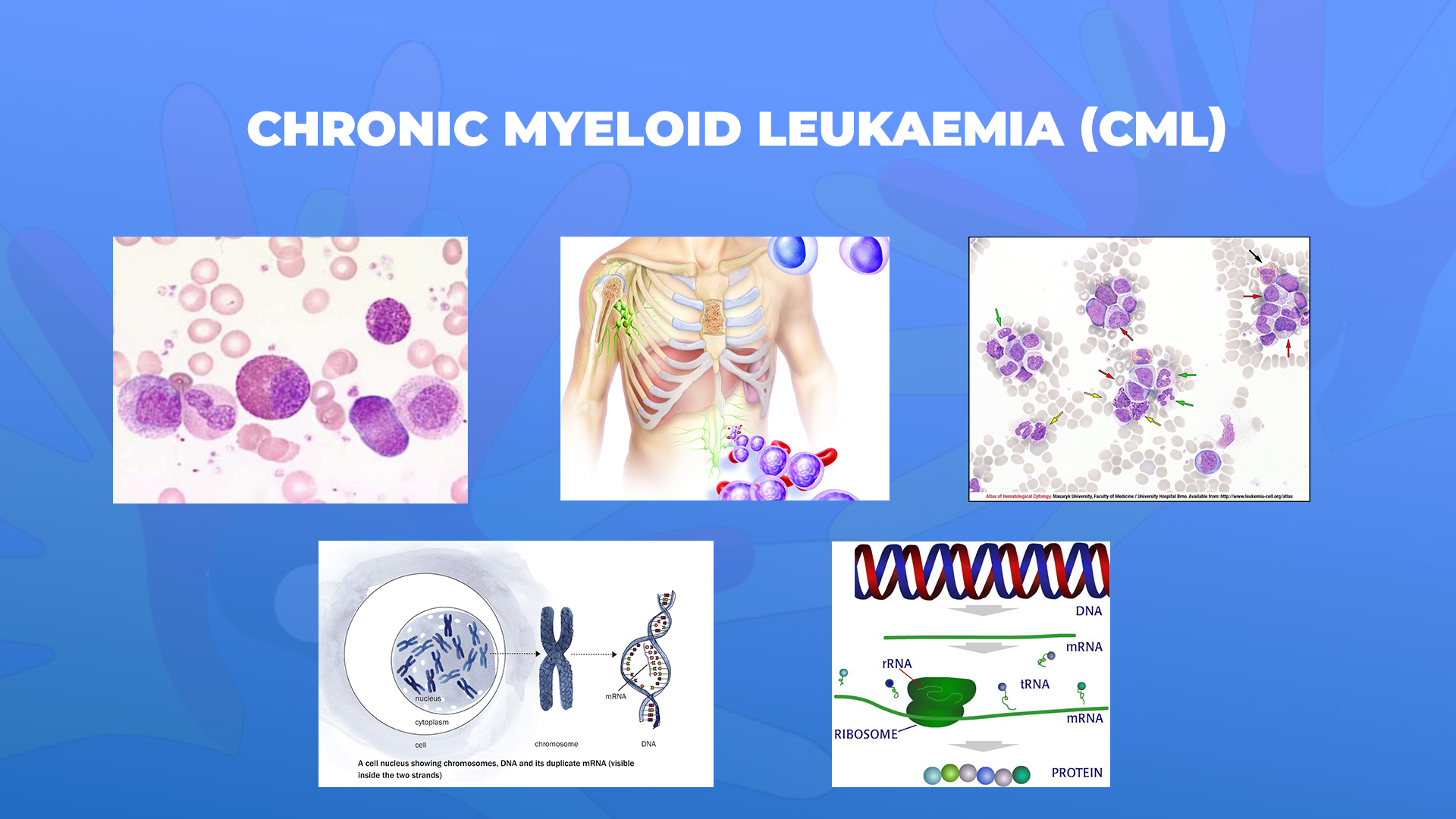 Leukoza Mieloide Kronike (Kanceri I Gjakut, Leuçemia Mieloide Kronike, LMC)