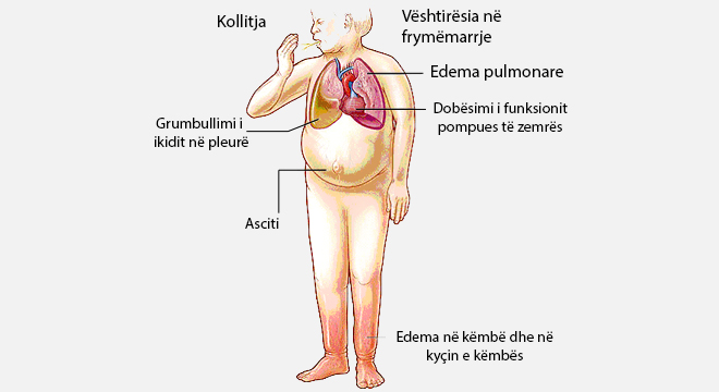 Insufiçienca Kardiake (Dobësimi I Punës Së Zemrës)