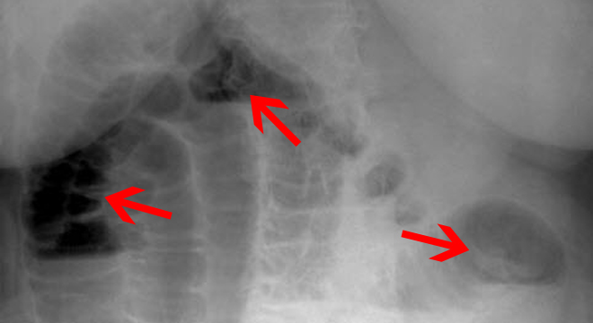 Bllokimi I Zorrës (Ileusi, Okluzioni Intestinal)