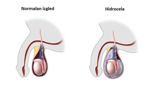 Hidrocela