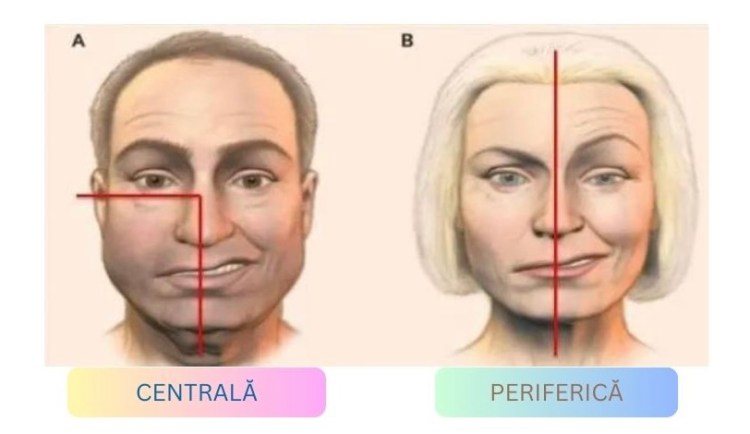 Paraliza Faciale (Pareza Faciale)