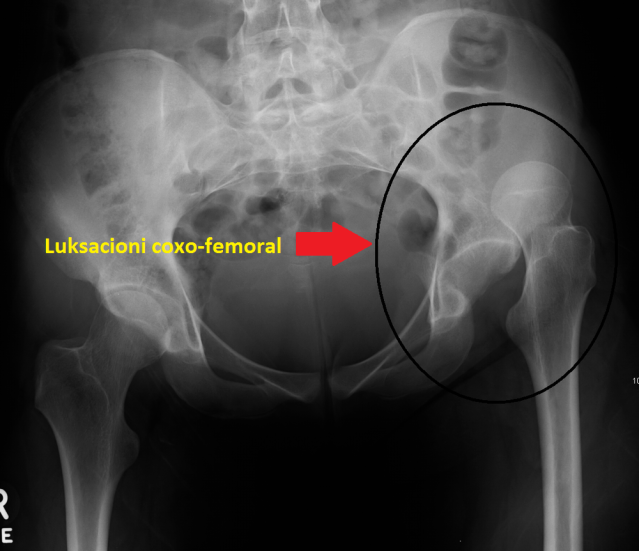 Luksacioni Coxo-femoral I Lindur (Keqformimi I Lindur I Legenit, Luksacioni Kongenital I Legenit, Zhvendosja E Lindur E Kockës Së Legenit, Zhvendosja E Lindur E Kokës Së Femurit)