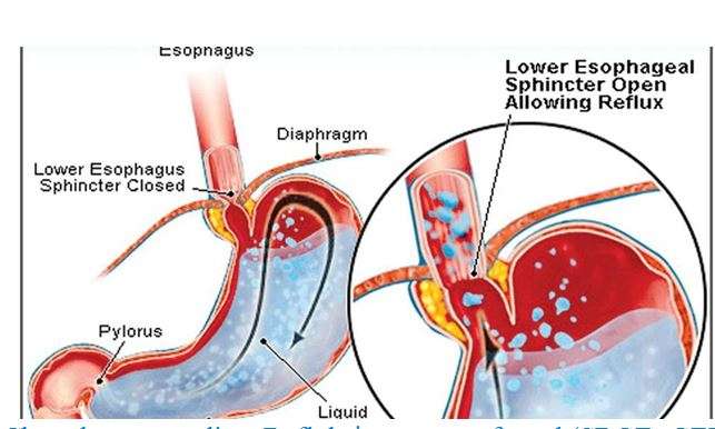 Sëmundja E Refluksit Gastro-ezofageal (Sëmundja E Refluksit, SRGE)