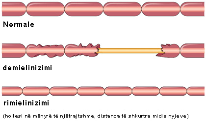 Skleroza Multiple (Skleroza E Shumëfishtë)