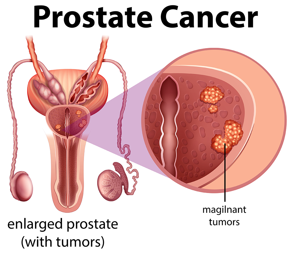 Çfarë Duhet Të Dimë Për Kancerin E Prostatës