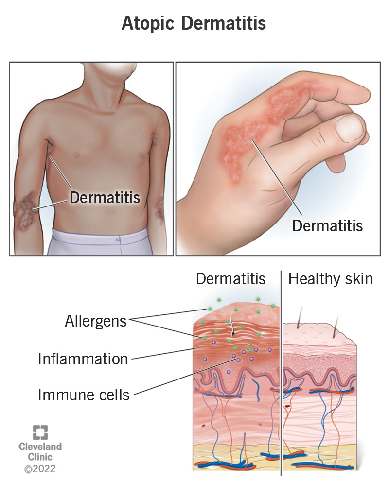 Trajtimi i dermatitit atopik cover images