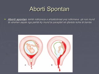 Aborti (Dështimi, Ndërprerja E Shtatzanisë)