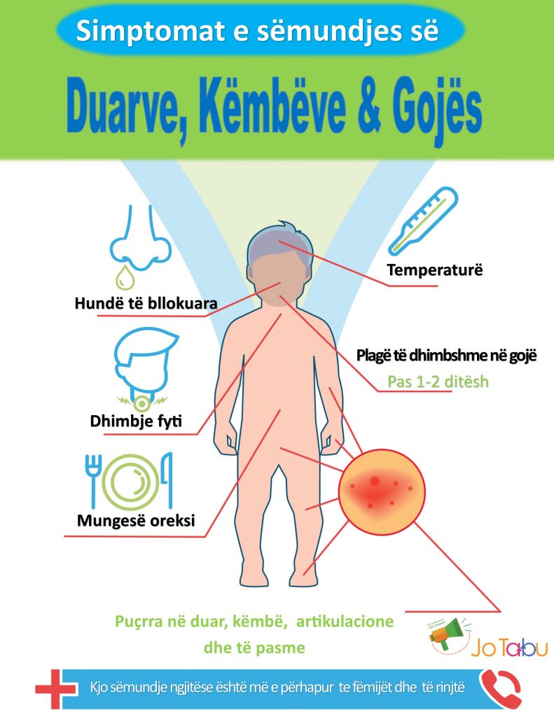 Sëmundja E Duarve, Këmbëve Dhe Gojës (SDKG)