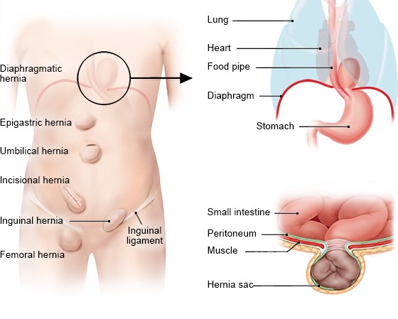 Hernia E Diafragmës (e Lindur)