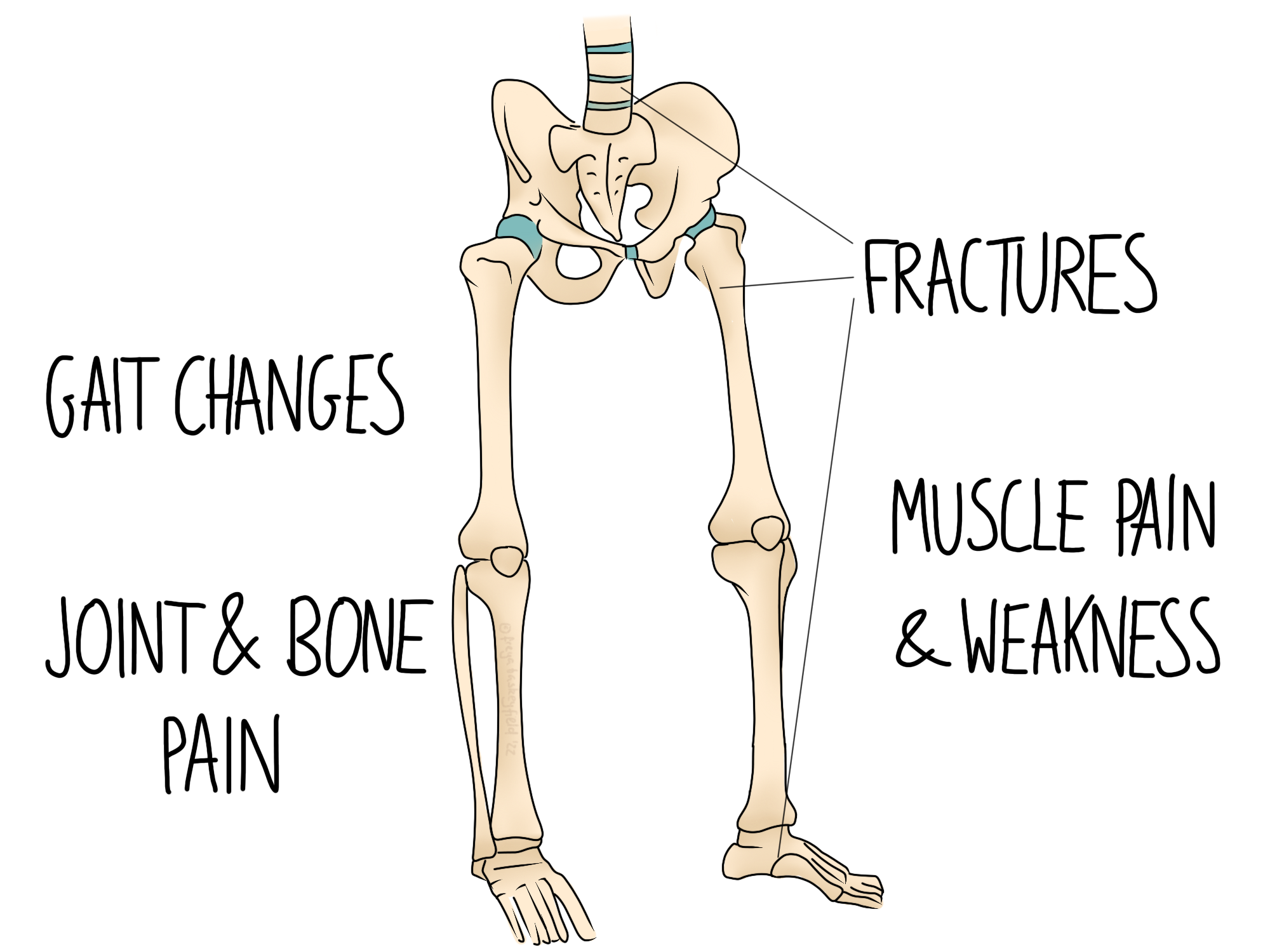 Rakitizmi (Mungesa E Viaminës D, Osteomalacia)