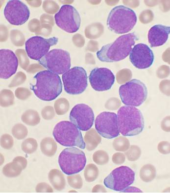 Leuçemia Akute (Leukemia Akute)