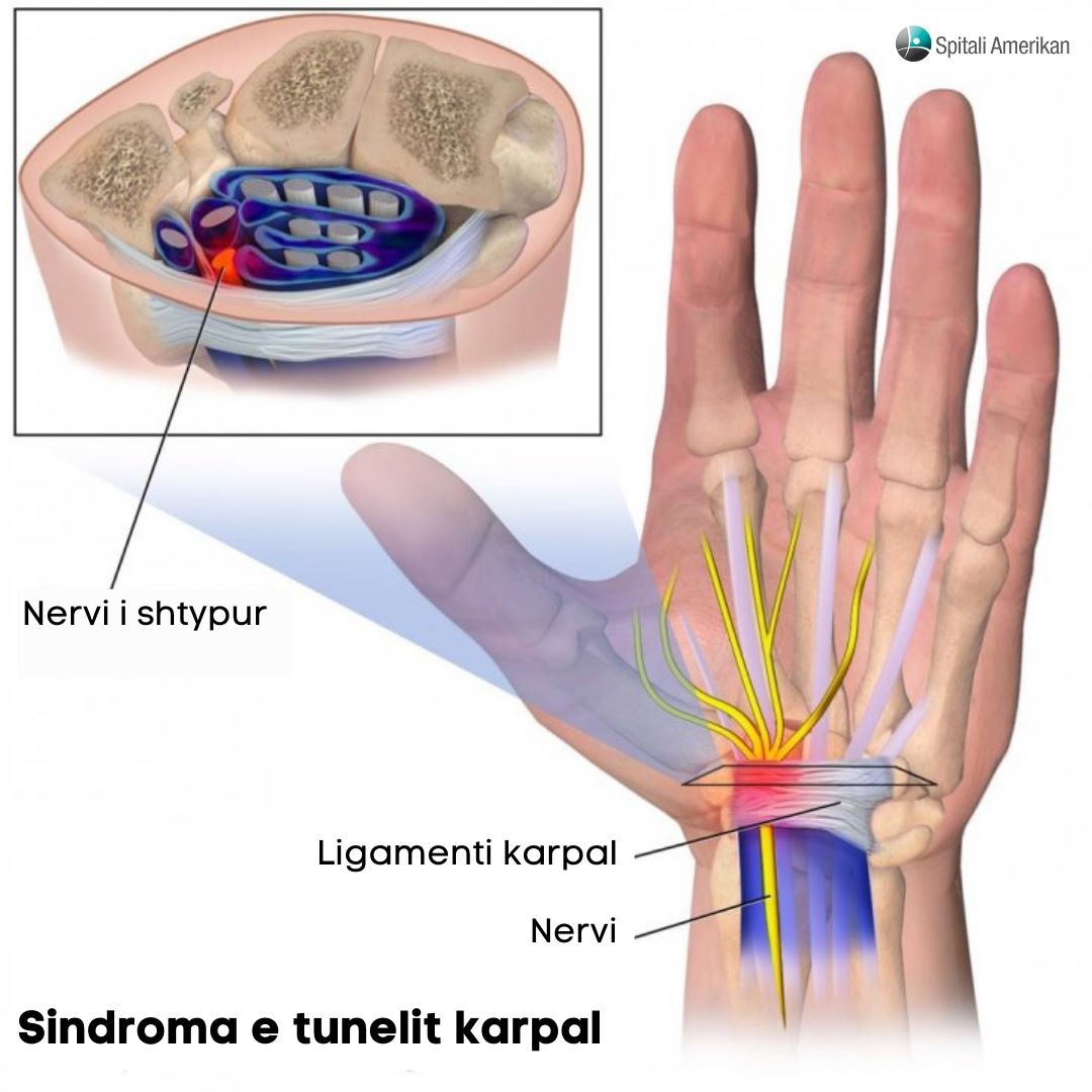 Sindroma E Kanalit Karpal (Sindroma E Tunelit Të Kyçit Të Dorës, SKK)