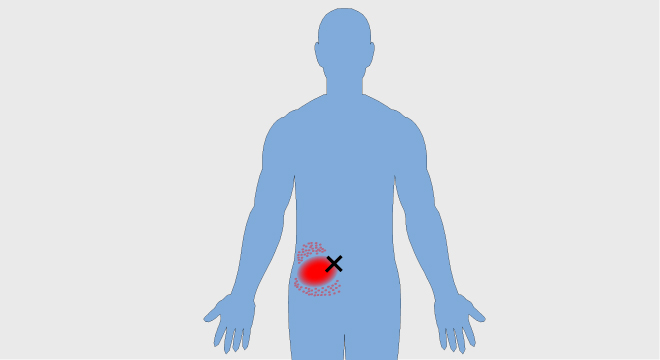 Abdomeni akut (Dhimbja e fortë e barkut)