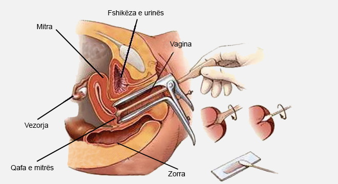 Kanceri I Qafës Së Mitrës (Karcinoma Cervikale)