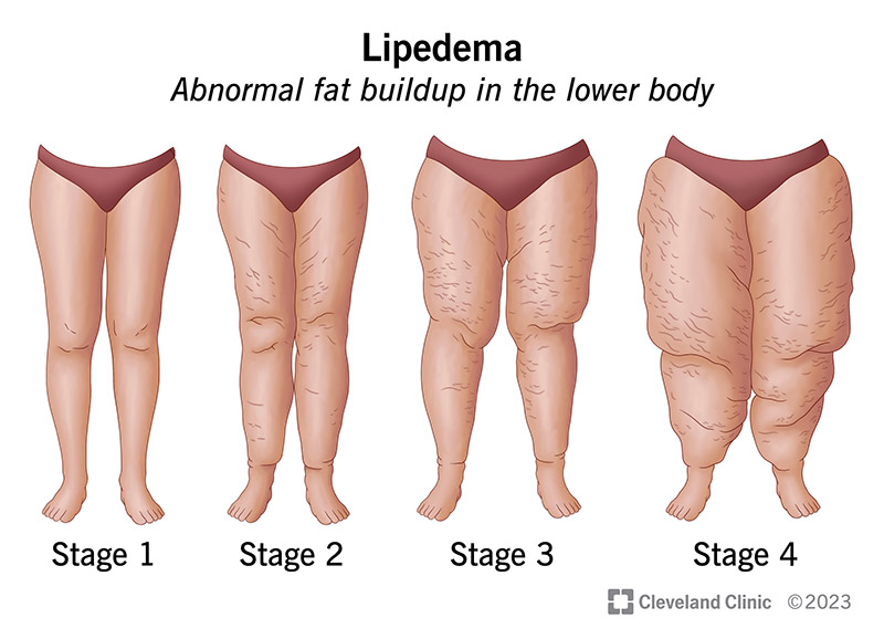 Lipedema