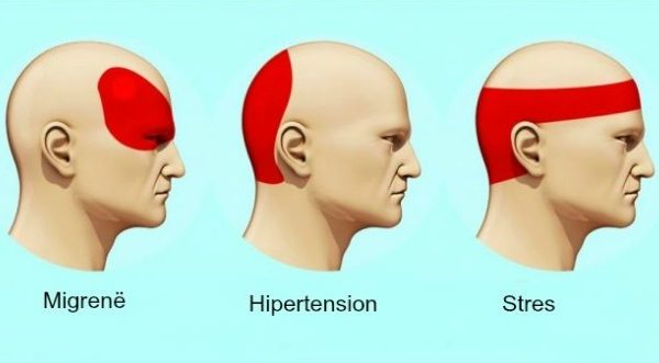 Pse kam dhimbje koke? Shkaqet, llojet dhe trajtimet