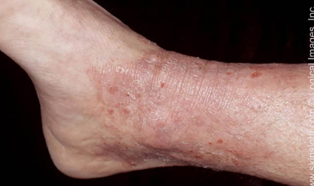 Neurodermatiti (Dermatiti Atopik, Ekzema Atopike, Ekzema Endogjene, Neurodermatitis)